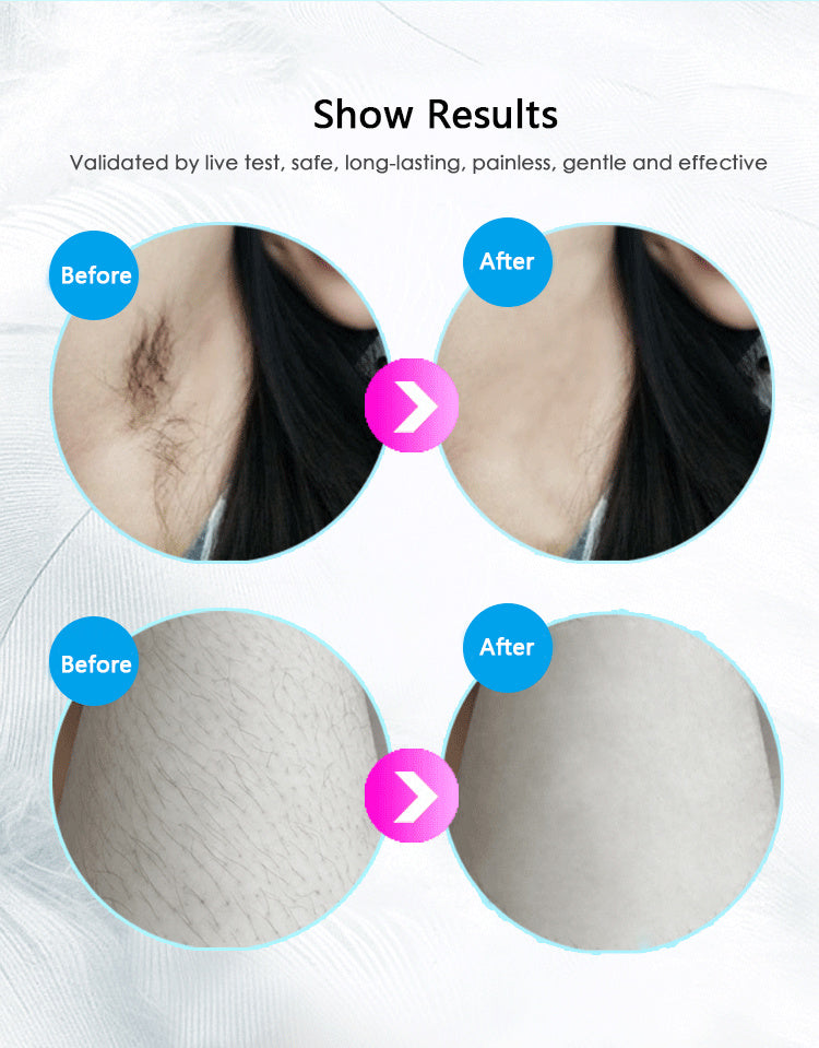 Before and after results showing smooth skin using permanent hair removal equipment for effective hair reduction